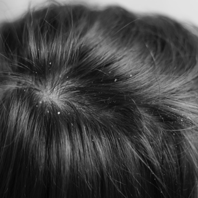 Dandruff and dry scalp with hair extensions