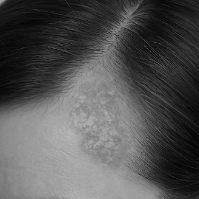 Psoriasis and eczema with hair extensions